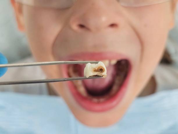 Best Emergency Treatment for Dental Infections or Abscesses in Navy, VA